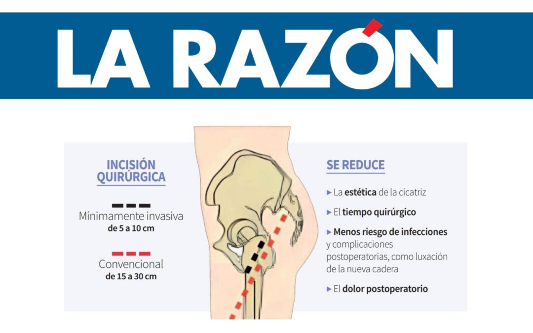 Prótesis de Cadera: la Cirugía Mínimamente Invasiva (CMI) reduce el tiempo de ingreso y acelera la recuperación del paciente